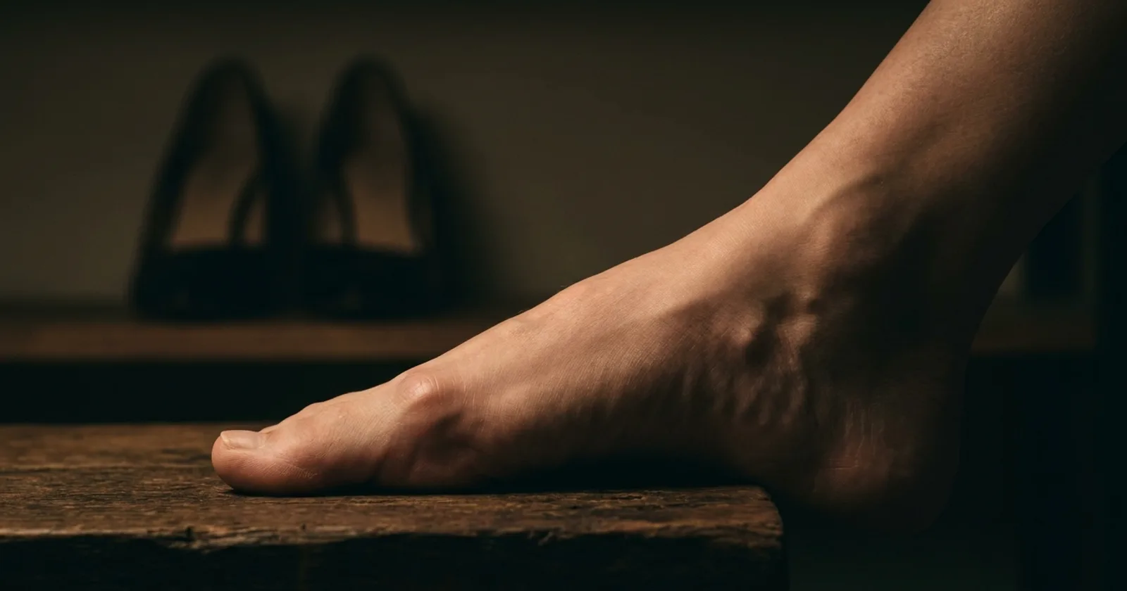 Pied présentant un hallux valgus (oignon) à la base du gros orteil