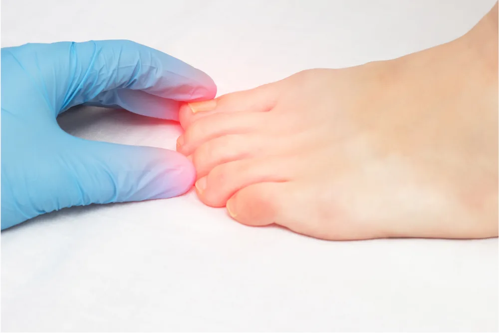 Ongle incarné du gros orteil, rougeur et douleur